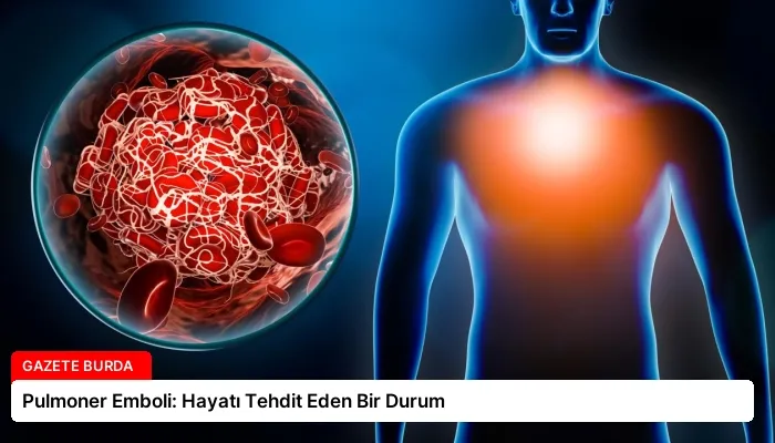 Pulmoner Emboli: Hayatı Tehdit Eden Bir Durum